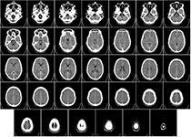 Neurology：缺血性脑卒中早期<font color="red">脑</font>老化的<font color="red">结构</font>性MRI标志