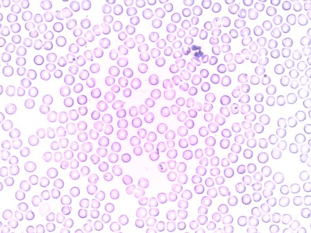 BMC Nephrol：<font color="red">白细胞</font>计数可预测肾脏病