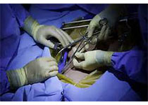JAMA Surg：腹腔镜与开腹结肠切除术医疗成本比较