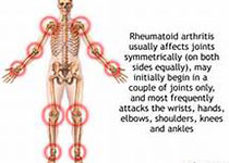 Arthritis Rheumatol：自身免疫性疾病患者外周血<font color="red">B</font>淋巴<font color="red">细胞</font>Bruton酪氨酸激酶活性增强
