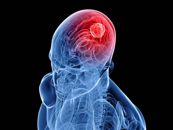 Sci Rep：脑组织缺乏“编辑”是脑癌的潜在驱动因素