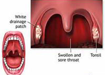 Oral Oncol：对口咽癌患者的<font color="red">高危</font>人乳头瘤病毒蛋白亚型特异性抗体的评估