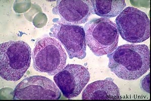 Nature：抗药性的<font color="red">干细胞</font>的存在是急性骨髓性<font color="red">白血病</font>复发的原因