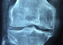 Arthritis Rheumatol：平板运动对大鼠骨关节炎疼痛的影响
