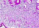 Lancet oncol：基因突变所导致肿瘤特异性抗原和<font color="red">免疫</font>表型