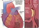 Int J Cardiol：年龄对血小板与淋巴细胞比值与冠状动脉疾病之间相关性的调节作用!