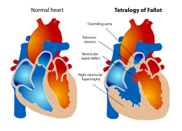 【盘点】先天性心脏病近期重要研究进展一览