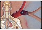 Heart：静脉血栓栓塞症患者对华法林和依度<font color="red">沙</font>班的遗传学和临床反应！