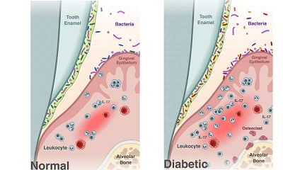 Cell Host & microbe：糖尿病引发的口腔微生物组改变影响牙周炎的发生