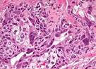 CANCER RES：三阴性乳腺癌高表达<font color="red">CDK7</font>与不良预后有关，可作为治疗靶点