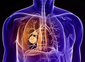 JAMA：质子束放射治疗和同步化疗治疗不能手术的III期非小细胞肺癌