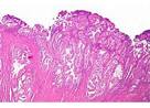 Ann Oncol：局部晚期<font color="red">头颈</font>部鳞状细胞癌的HPV状态是否能决定其有效化疗方案（EORTC 24971研究的亚组分析）