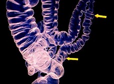 Inflamm bowel dis：溃疡性结肠炎患者早期结肠全切除风险的临床预测分析