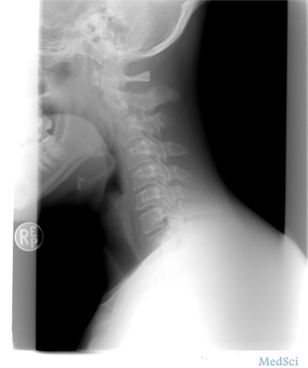 世界先例 上海专家3D打印全颈椎助患者颈椎“再生”