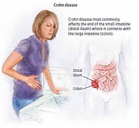 Gastroenterology：克罗恩病术后使用生物制剂的困境