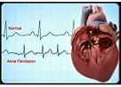 JAMA：血钙水平相关基因突变与心血管疾病风险