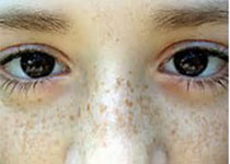 J Am Acad Dermatol：皮肤科门诊咨询对儿童肿瘤患者的诊断和治疗的影响如何？