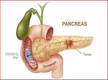 JCO：散发胰腺癌患者的有害胚系突变