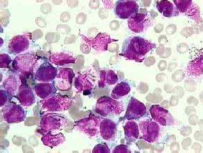 JCO：“砒霜”可减少急性早幼粒细胞白血病中蒽<font color="red">环</font>类药物剂量