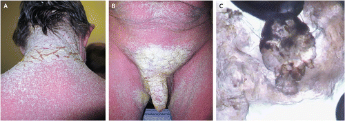 NEJM：头皮、手上和生殖区都有红斑和鳞屑，什么病？