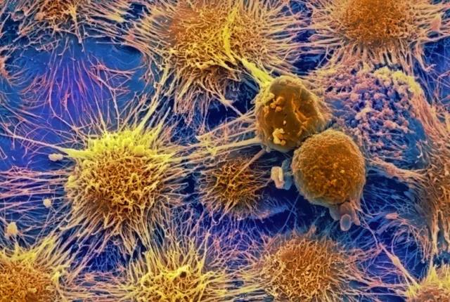 Mol Cancer：研究发现吉西他滨抗性细胞转移其恶性特征的机制