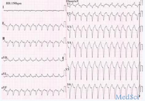 心电图诊断致心律失常性右室心肌病 表现和注意事项有哪些？