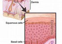J Am Acad Dermatol：Vismodegib治疗皮肤基底细胞癌，并不会增加鳞状细胞癌风险