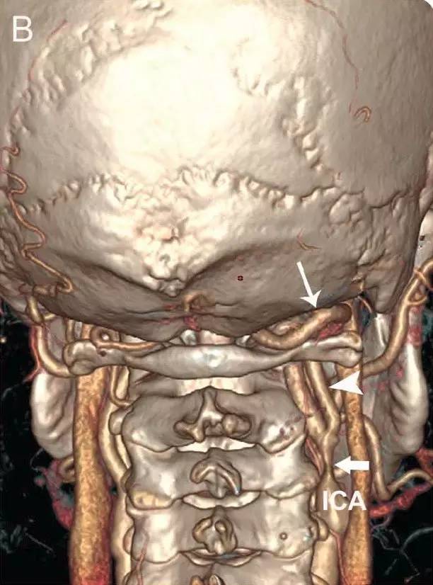 寰前节间动脉图片