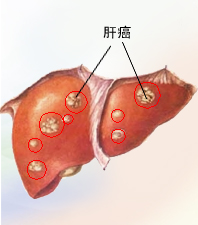 JAMA Oncol: 个体化自适应<font color="red">立体</font><font color="red">定向</font>放疗治疗肝癌 结果超预期