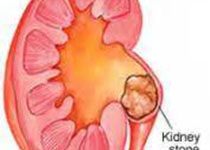 Am J Kidney Dis：成人肾<font color="red">结石</font>和亚临床冠状动脉钙化有何关系？