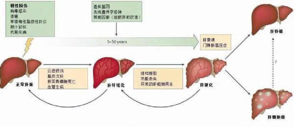 Gut：关乎上亿肝病患者，中国研究人员参与发现阻断肝硬化新机制，填补领域空白！