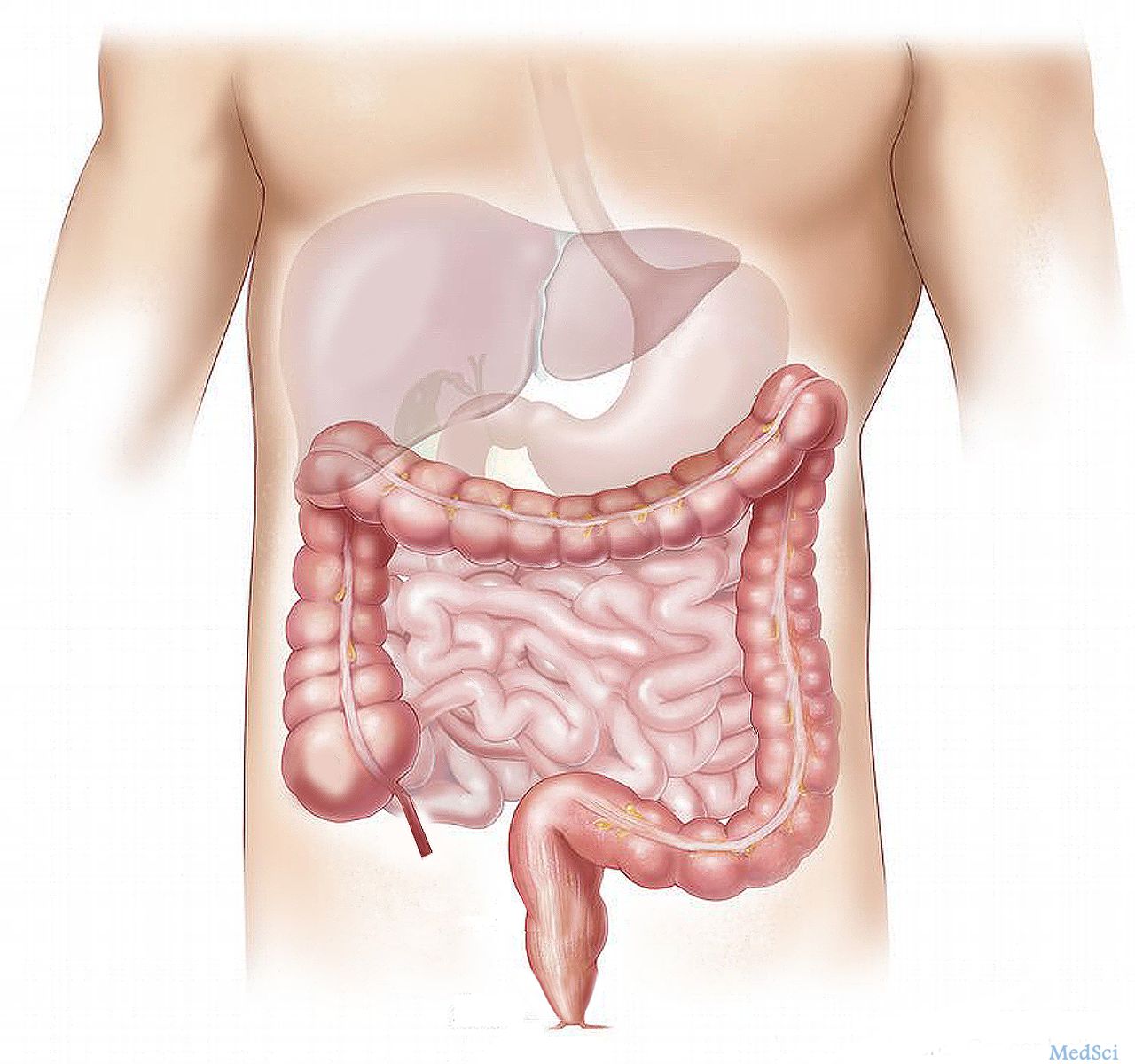 Gut：慢加急性肝衰竭与细菌感染的相互影响