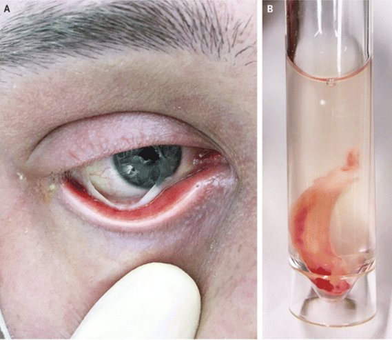 伴有假膜的眼部急性gvhd是造血干细胞移植可能出现的并发症,其与预后