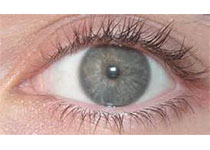 J Glaucoma：钕掺杂钇铝石榴石<font color="red">激光</font>外<font color="red">周</font><font color="red">虹膜</font>切割术后引起慢性葡萄膜炎！