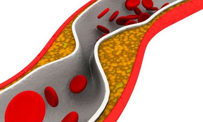 JACC-Cardiovasc imag：冠状动脉<font color="red">钙化</font>是确定心血管疾病早期风险的“风向标”