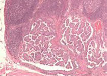 Lancet oncol：吉西他滨和多西他赛与阿霉素分别作为晚期或转移性软组织肉瘤的<font color="red">一</font>线<font color="red">疗法</font>的效果对比。