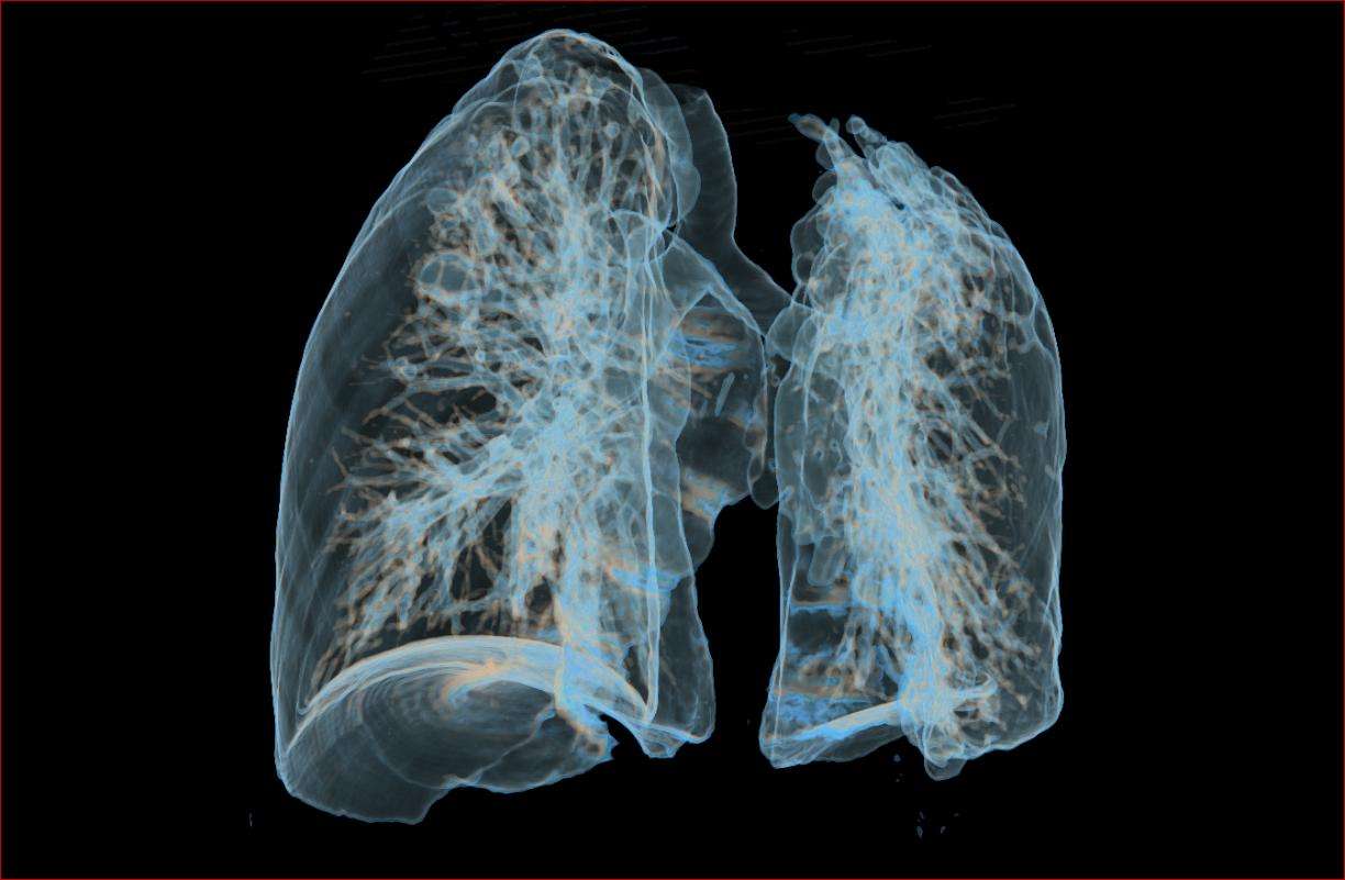 J Thorac Oncol：研究揭示肺癌发展中留下的“蛛丝马迹”！