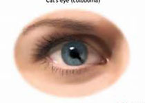 Prog Retin Eye Res：青光眼性视盘出血发病机制的新假说！