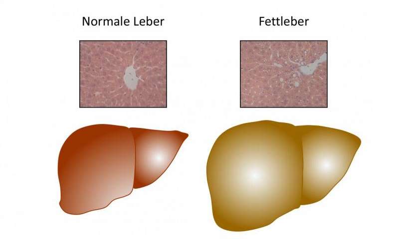 Nat Commun：研究揭示<font color="red">脂肪</font>肝形成的重要诱因！