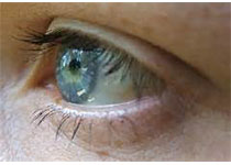 Int Ophthalmol：固定在睫状体沟后C-flex 570C人工晶状体出现视力模糊症状！