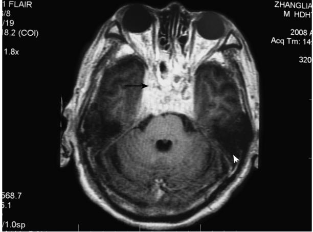 结核性脑膜炎引起的脑神经麻痹 如何早期诊断？