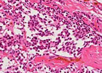 Lancet oncol：Dacomitinib用作携带EGFR突变的<font color="red">非</font>小细胞肺癌的一线<font color="red">疗法</font>的疗效和安全性。