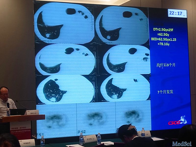 【CSCO 2017】王颖杰教授：有效应用现代放疗技术，减少肿瘤放疗血小板降低几率