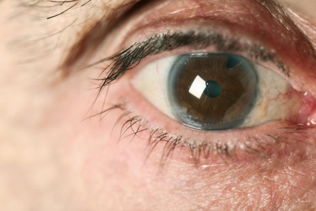 Sci Rep：这种天然蛋白质可治疗青光眼等，预防失明