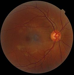 Nat Commun：<font color="red">眼部</font>免疫细胞有望治疗视网膜病变