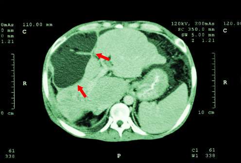 Gastroenterology：研究发现一种肝癌形成的重要原因！