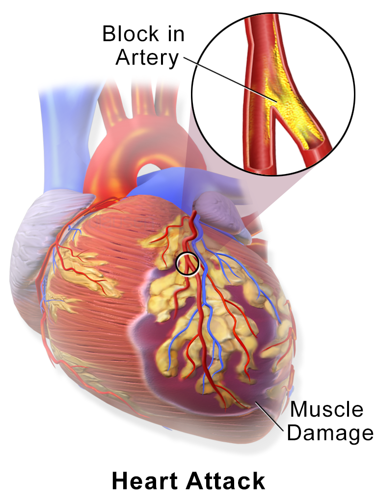 CIRC RES：心脏病患者的救星：基因的<font color="red">过度</font>表达增强了死亡肌肉的修复