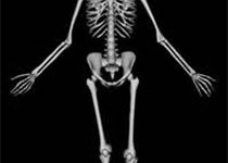 Bone：研究揭示MVNP在Paget病患者中的作用机制