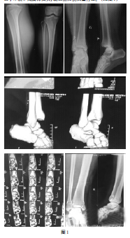 临床治疗踝关节多发韧带损伤1例
