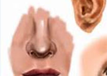 Int J Oral Max Surg：鼻假体对于美学和功能的修复